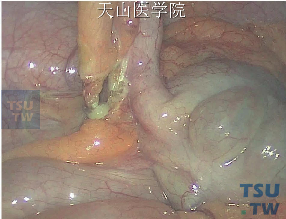 夹闭后的阑尾动脉