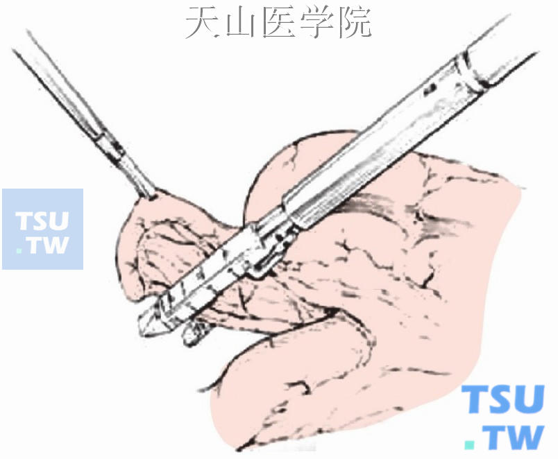 线型切割吻合器离断阑尾系膜