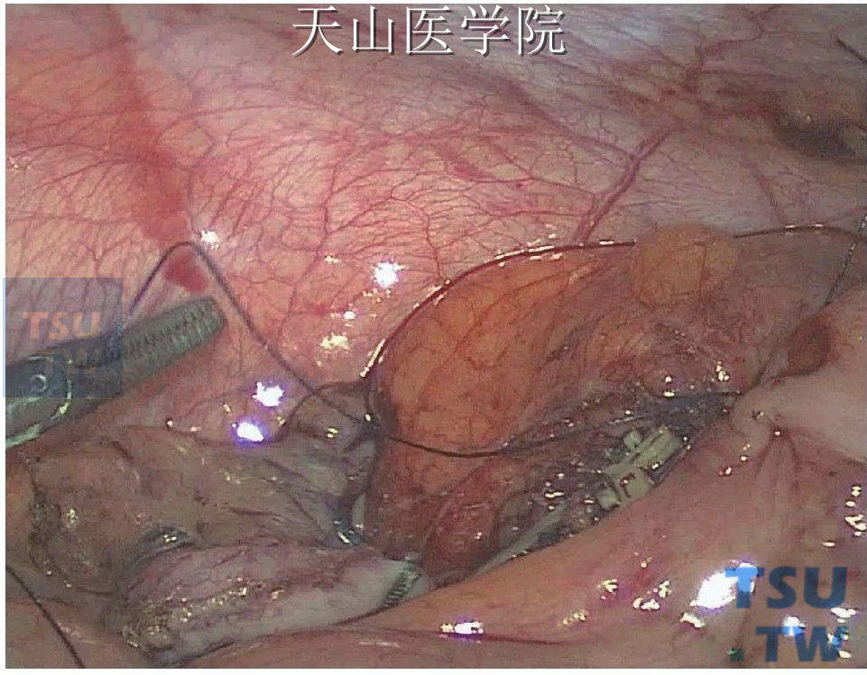 残端完全埋入后