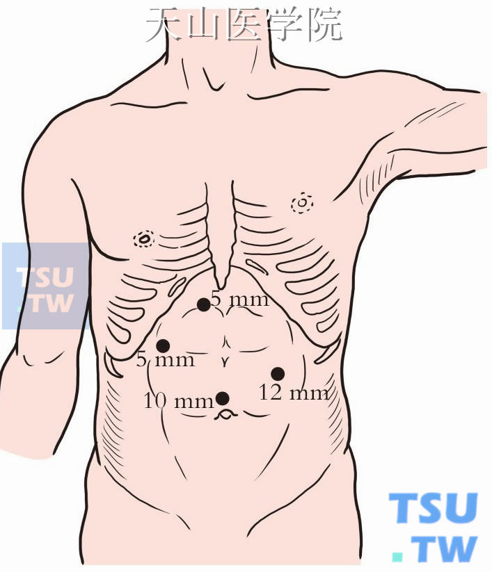 腹部穿刺鞘放置示意图（前路手术）