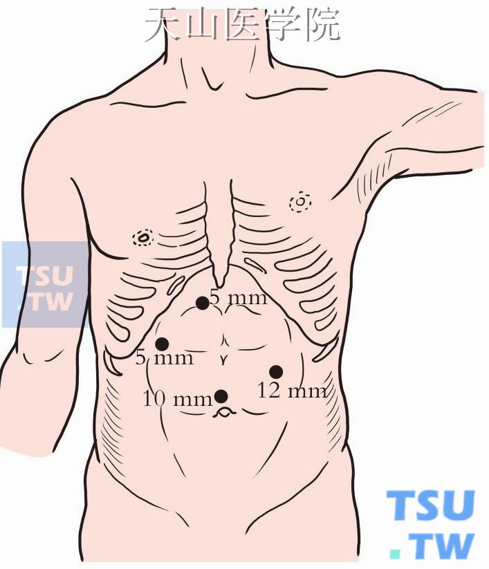 腹腔穿刺 图解图片