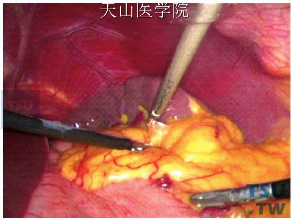 超声刀分离脾脏周围粘连