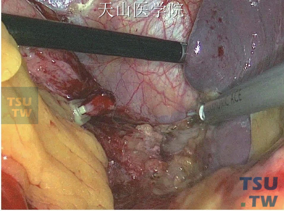 超声刀游离脾膈韧带