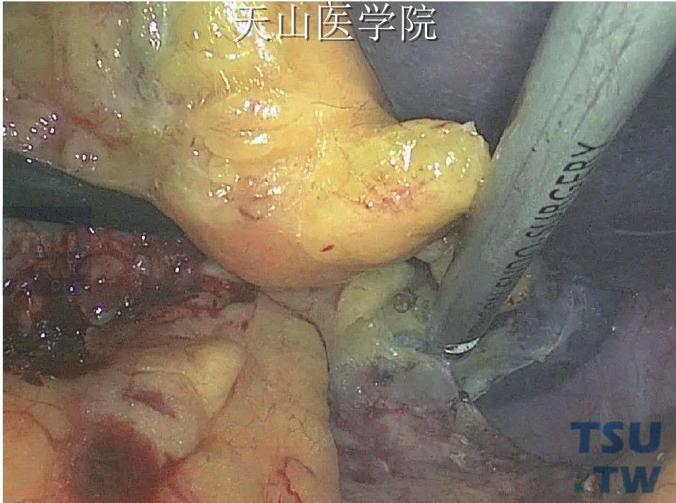 超声刀游离脾肾韧带