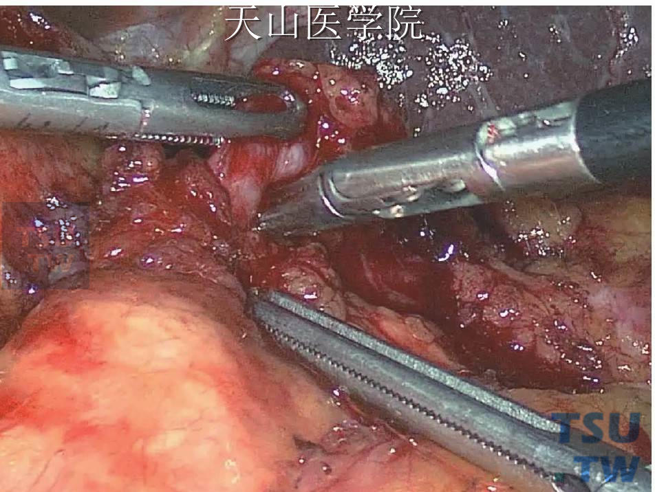 分离钳仔细游离脾门处血管