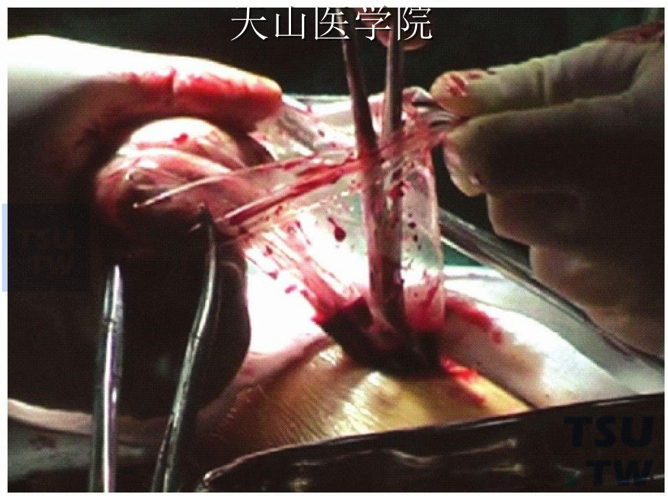 将标本袋口牵出腹腔外，卵圆钳将脾脏夹碎后取出