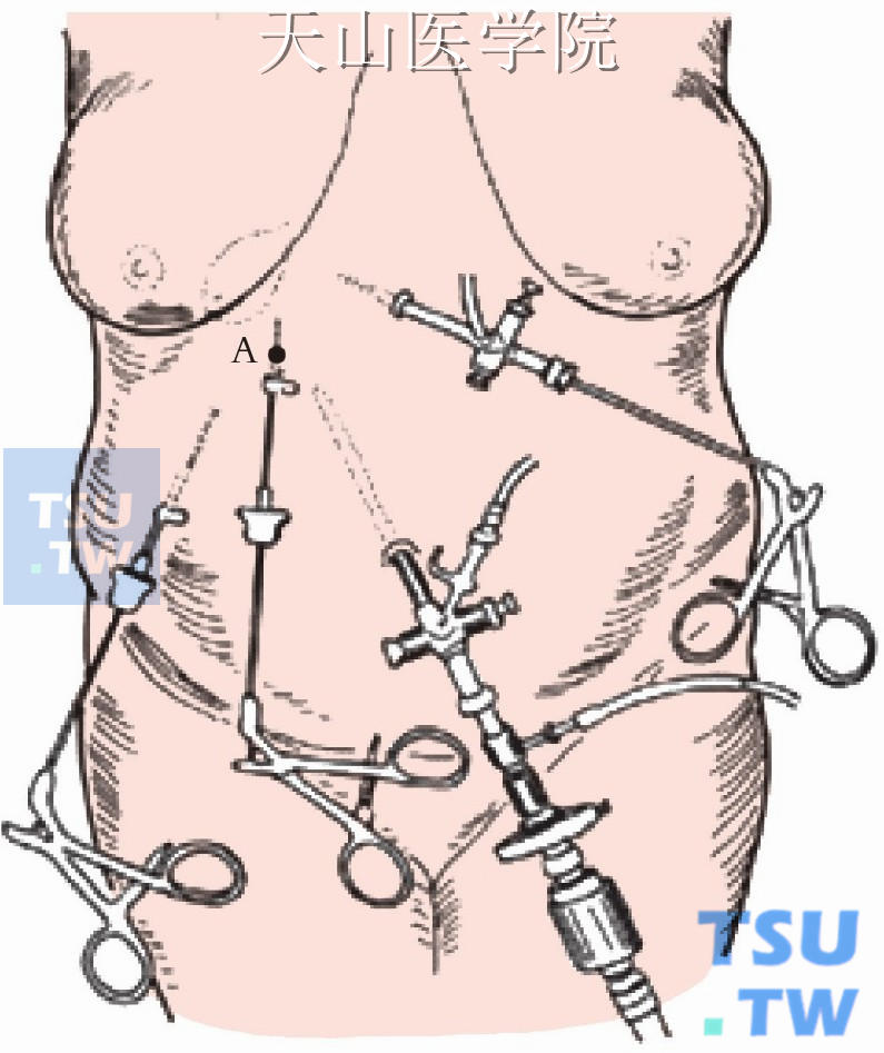腹部穿刺鞘放置示意图
