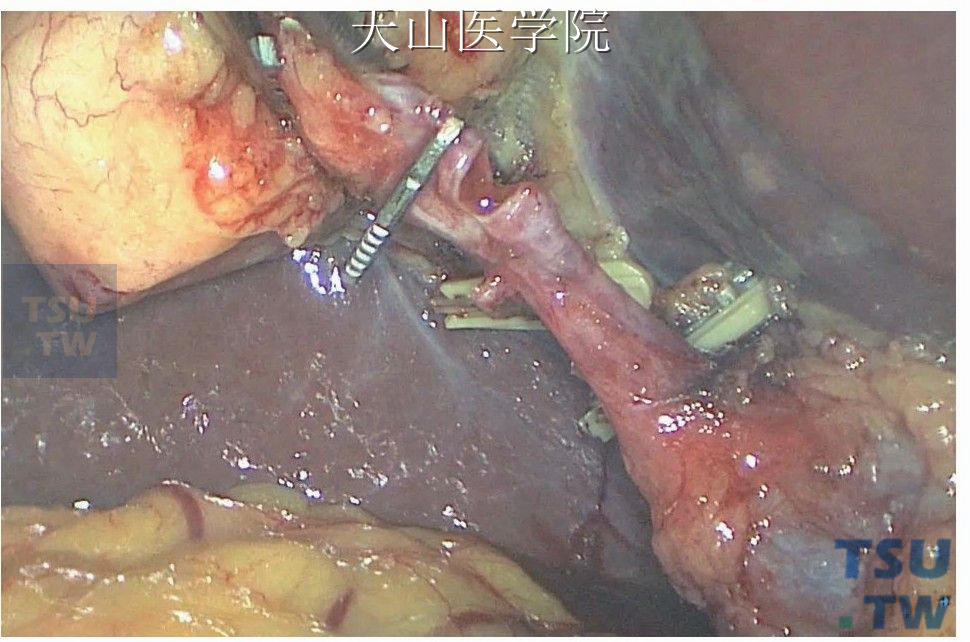 夹闭胆囊管远端，近端电灼后剪开1/3周径