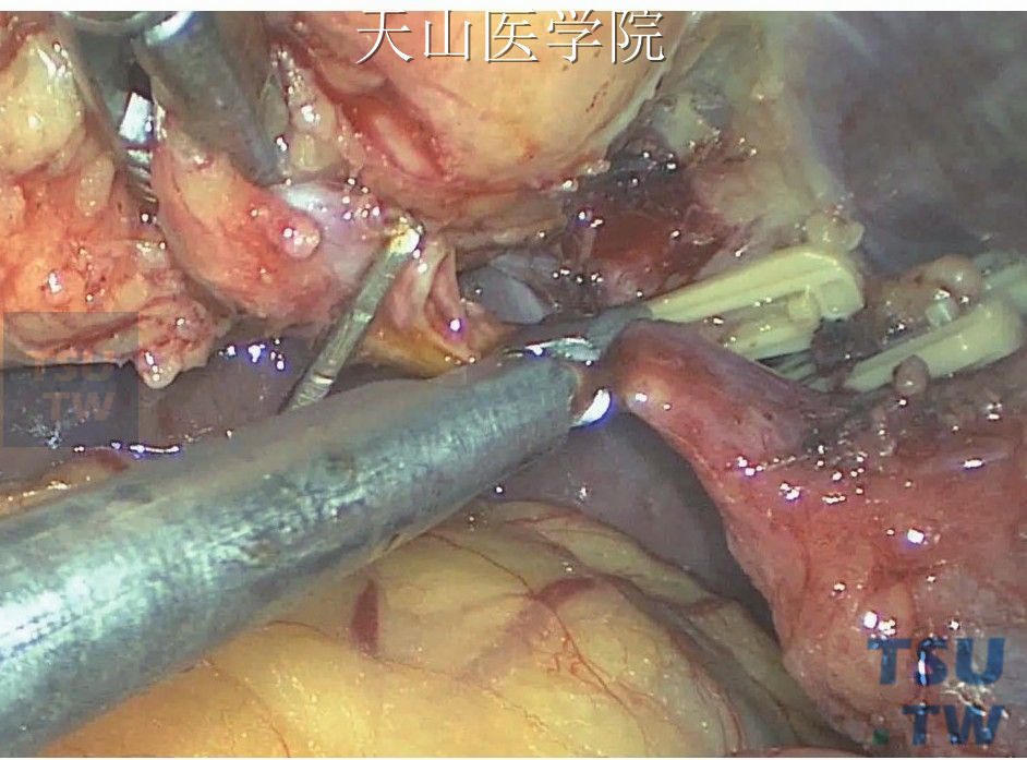 腹腔镜胆总管探查术