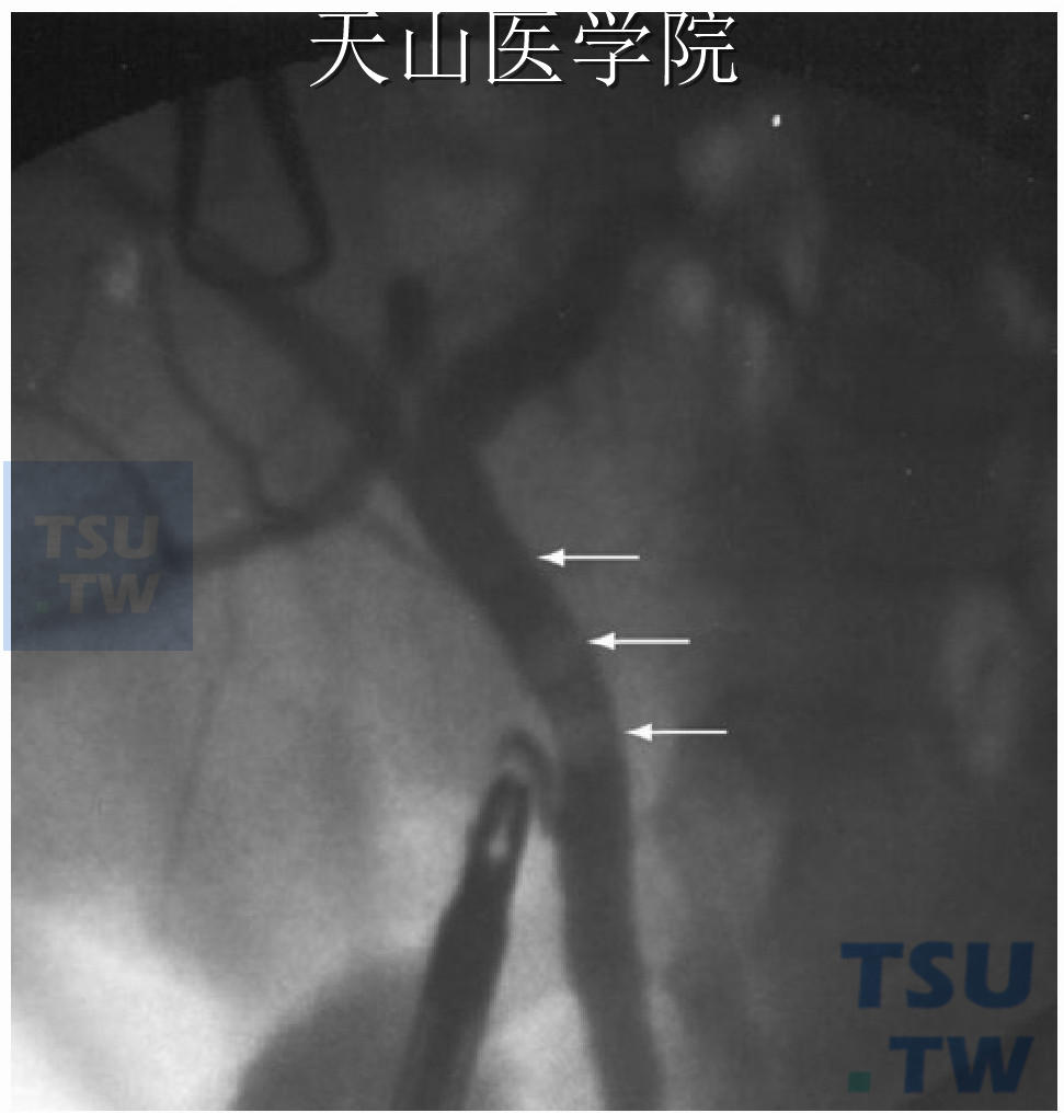 术中胆管造影图像