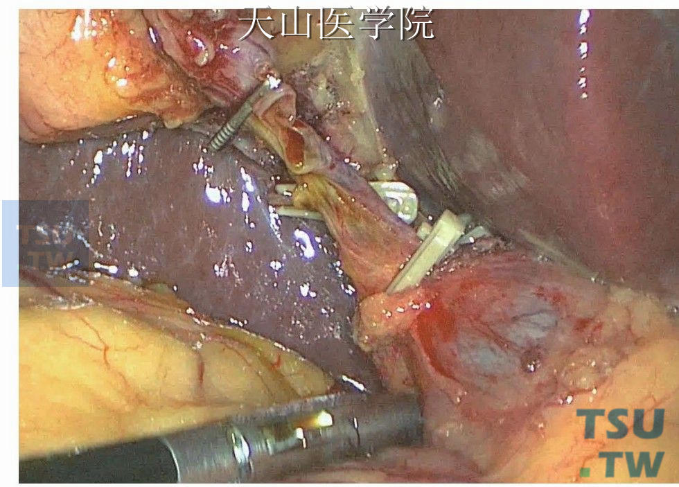 钛夹或可吸收夹夹闭胆囊管残端