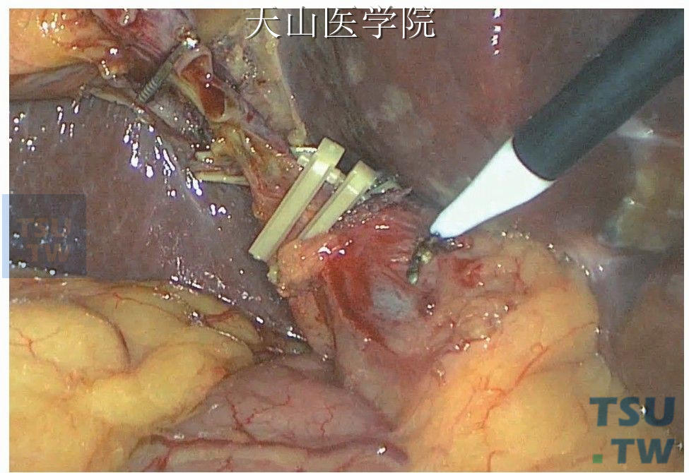 快速电凝胆管前壁预切部位，防止出血