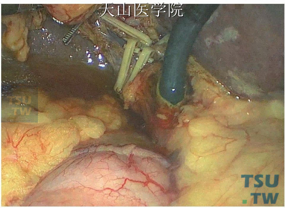 胆总管内置入胆管镜