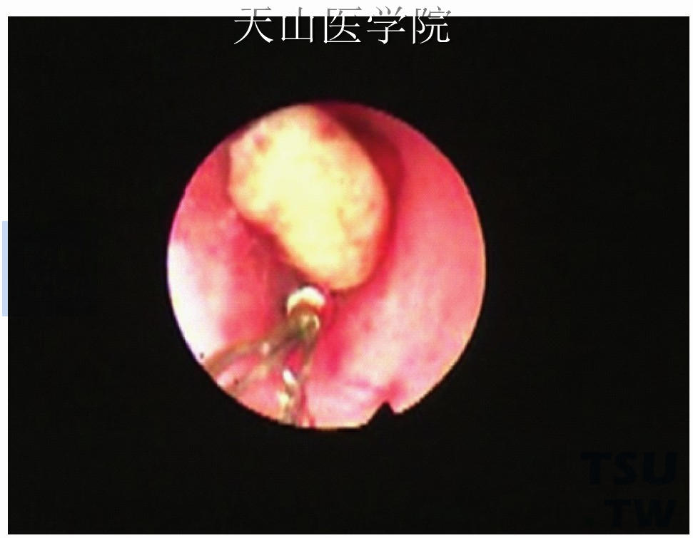 网篮置入结石附近准备取石