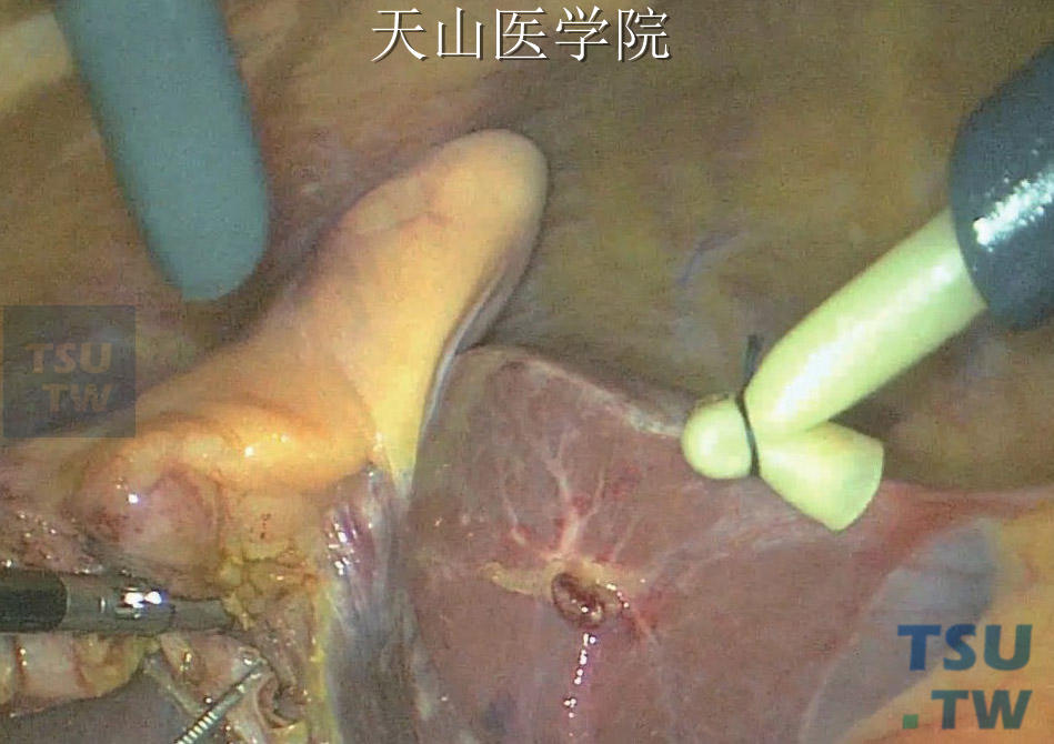 胆管结石放T管图片图片