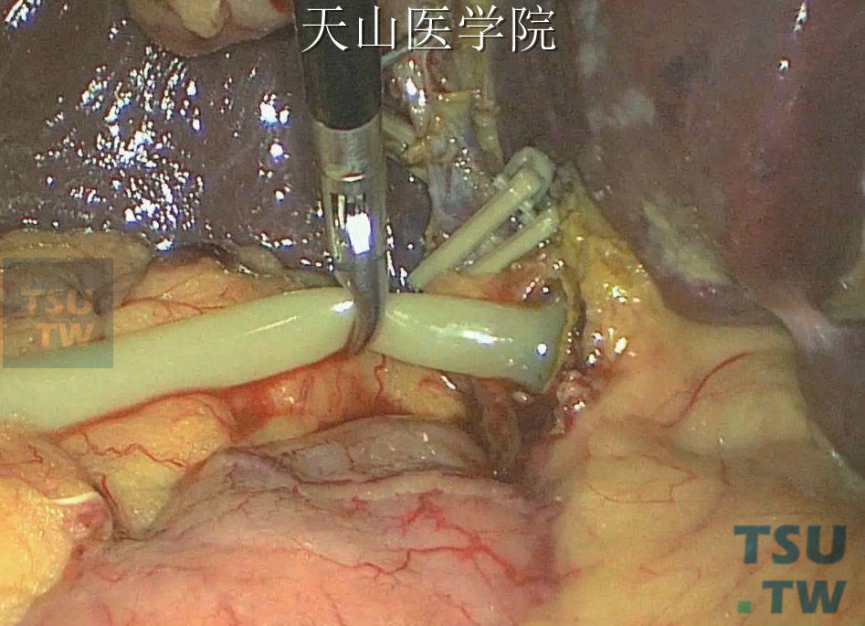 胆管结石放T管图片图片