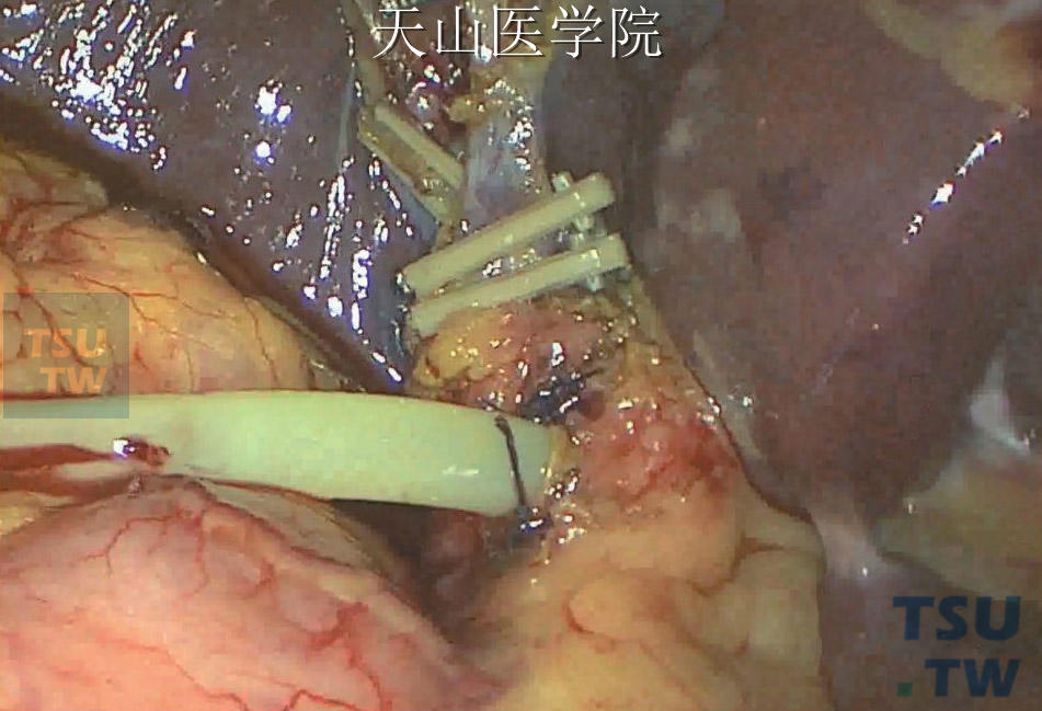 缝合胆总管前壁