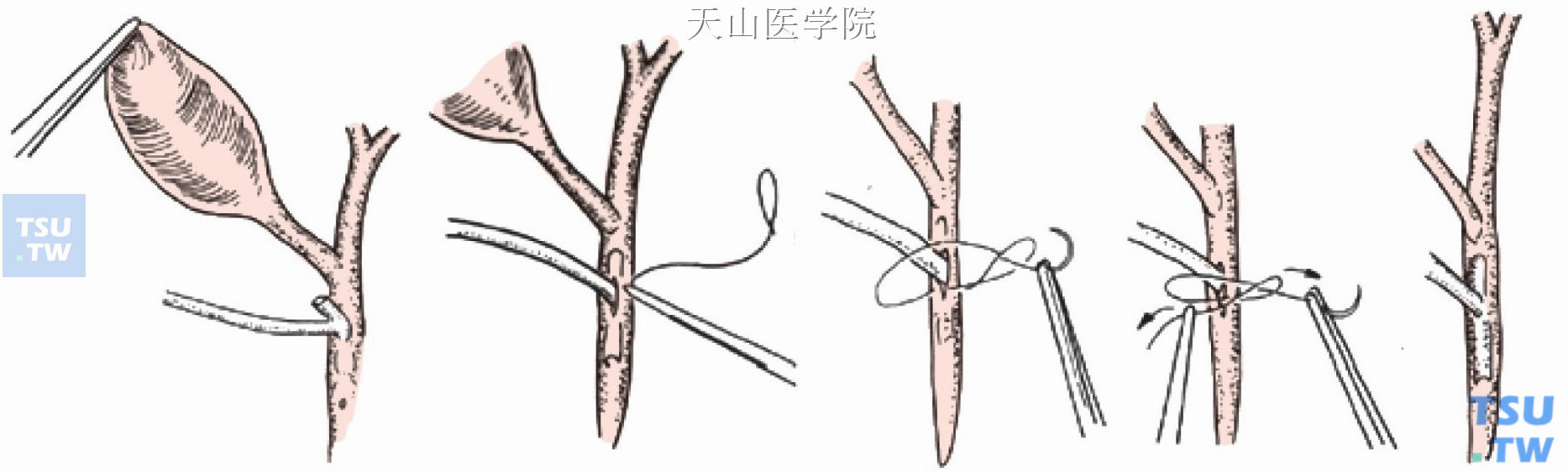 手术过程示意图