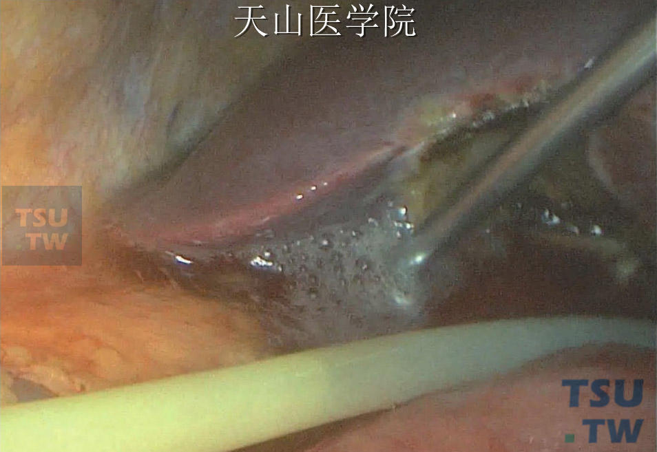 冲洗腹腔及盆腔，防止胆汁性腹膜炎