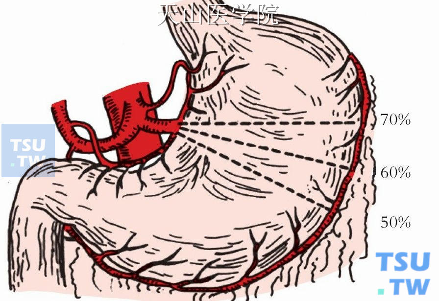 胃的切除比例的位置