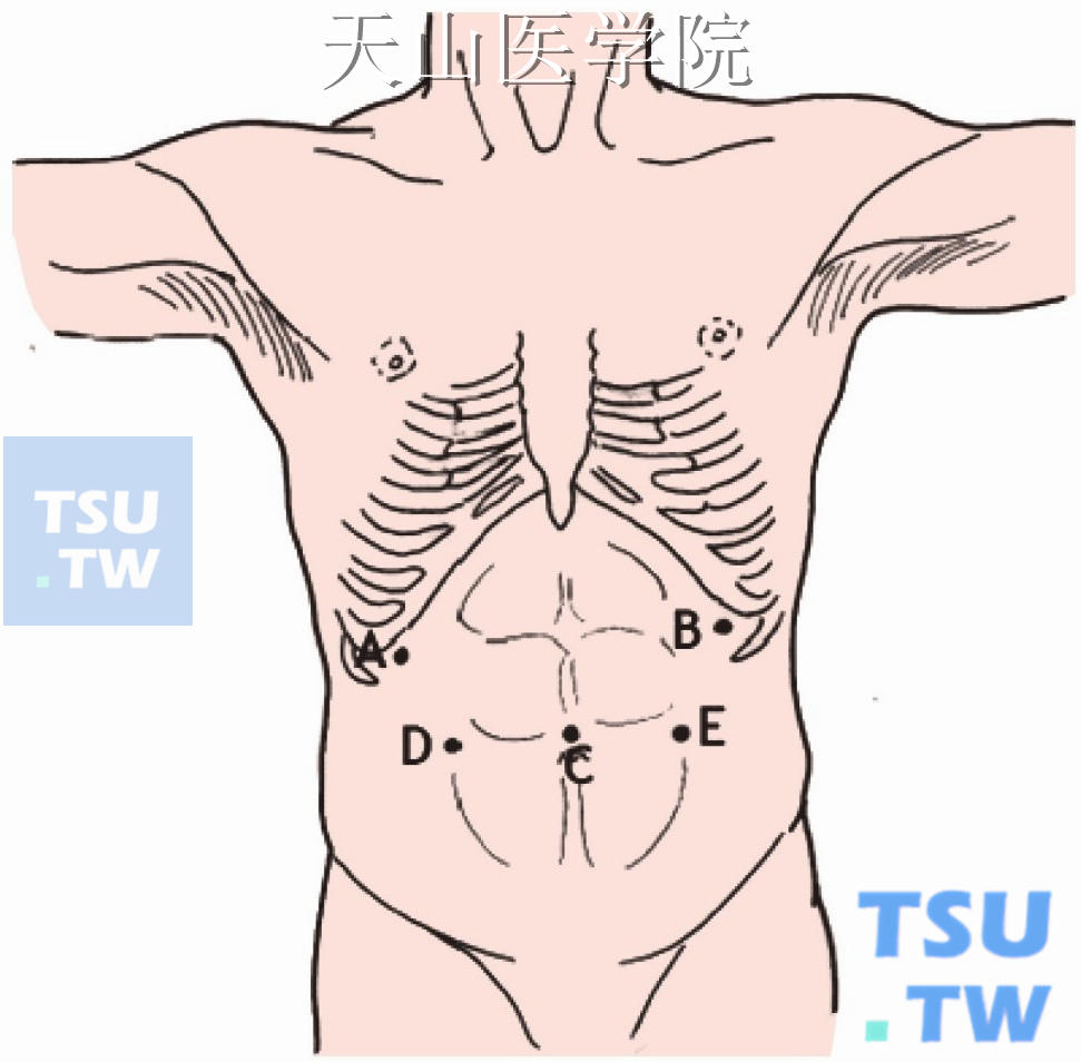 腹部穿刺鞘放置位置示意图