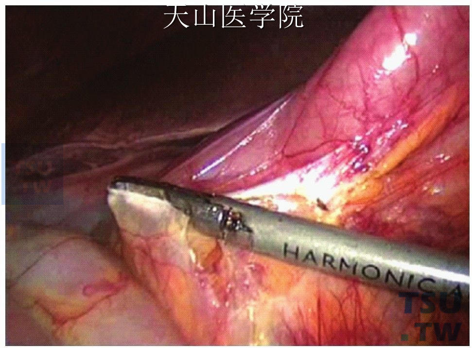 胃大弯血管弓外超声刀分离胃结肠韧带