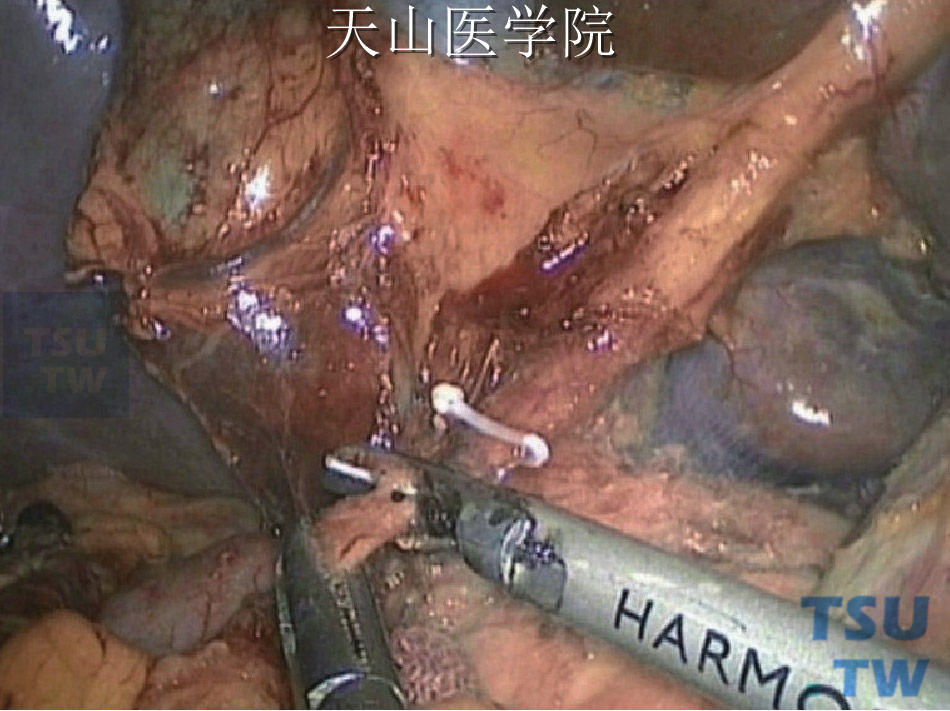 腹腔镜远端胃大部切除术