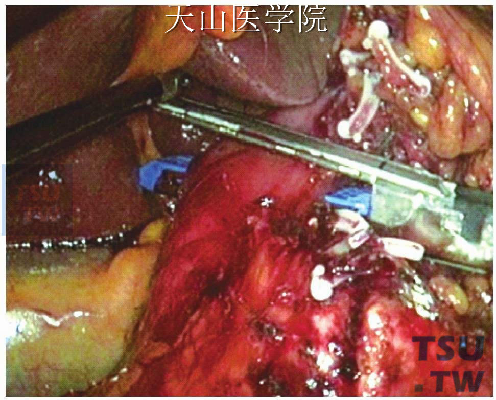 Endo-GIA切割闭合十二指肠起始部