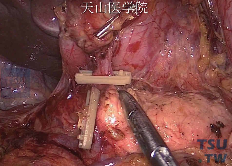 胃网膜右动静脉至根部离断