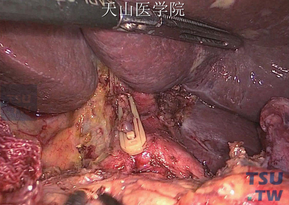 解剖肝十二指肠韧带