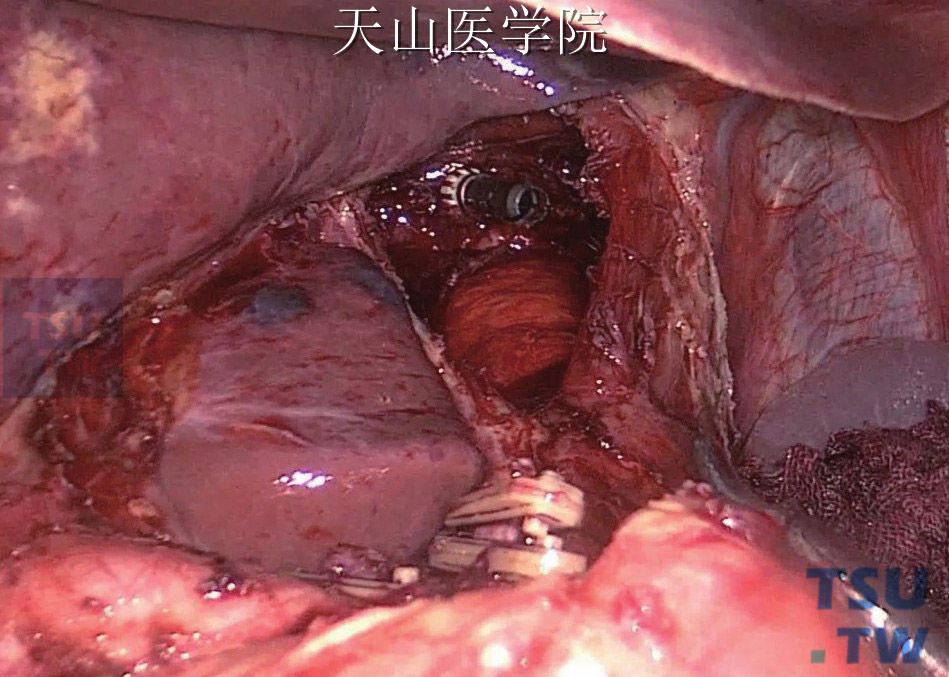 食管内置入吻合器抵钉座