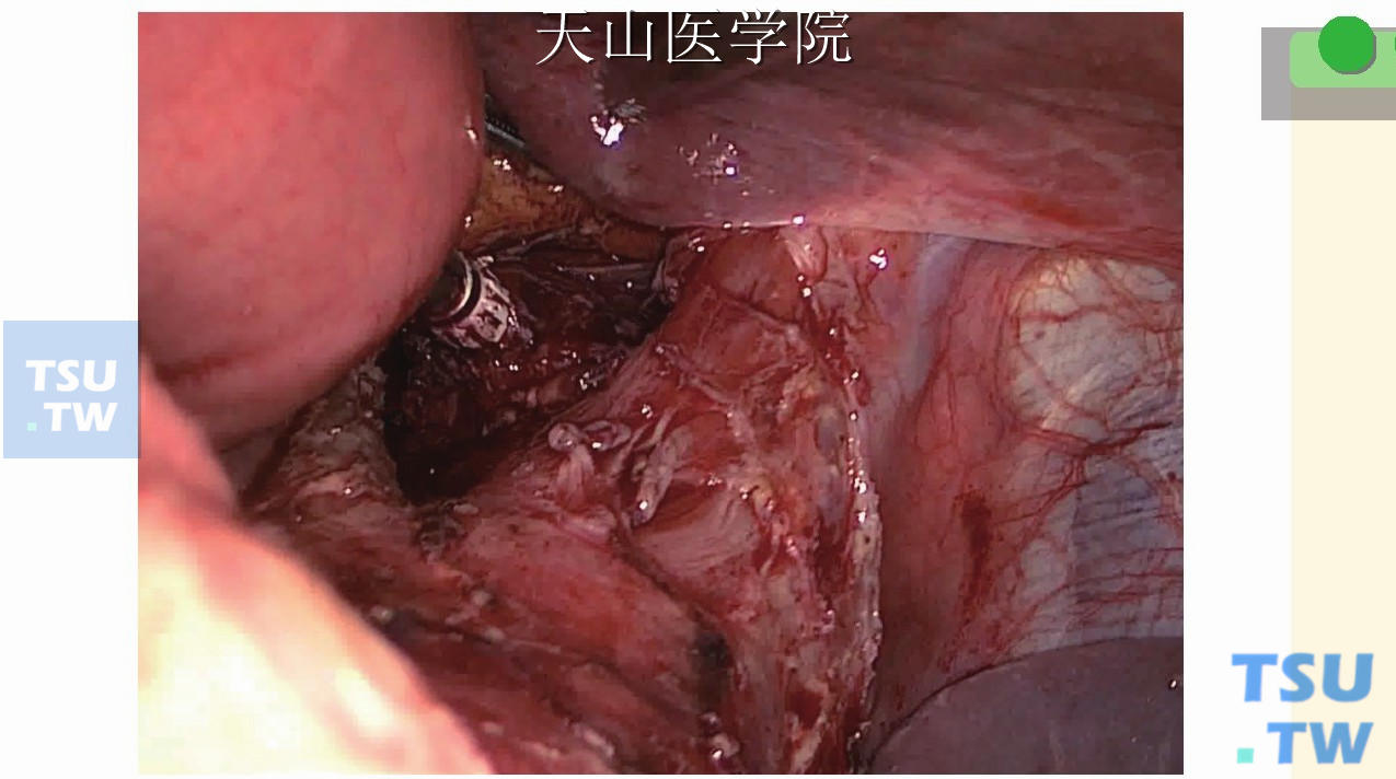 进行食管空肠端侧吻合