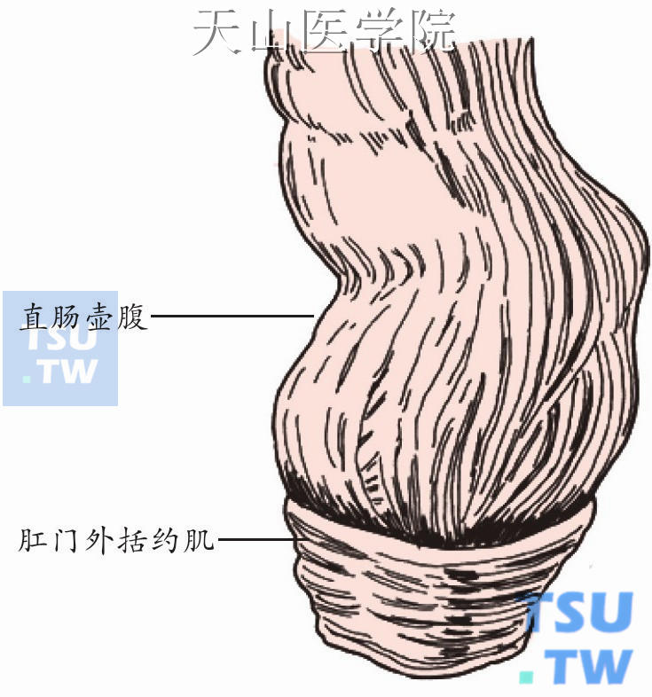 应用解剖  直肠盘曲于骶尾骨形成的穹隆内。由疏松的结缔组织将其固定于盆后壁。直肠上端在第3骶椎平面，上接乙状结肠，在齿线处与肛管相连，长12～15cm。直肠上端的大小似结肠，其下端扩大成直肠壶腹，是粪便排出前的暂存部位，最下端变细接肛管。直肠在盆腔内的位置与骶椎腹面关系密切，与骶椎有相同的曲度。直肠在额状面有向左、右方向凸出的弯曲，当行乙状结肠镜检查时，必须注意这些弯曲，以免损伤肠壁。直肠上1/3前面和两侧面有腹膜覆盖；中1/3前面有腹膜，并向前反折形成直肠膀胱陷凹或直肠子宫陷凹；下1/3全部位于腹膜外，故直肠为腹腔内外各半的肠道。直肠无真正系膜，但其上后方，腹膜常包绕直肠上血管和蜂窝组织，有人称此为直肠系膜。在两侧有侧韧带将直肠固定于骨盆侧壁。直肠壶腹部粘膜有上、中、下3个皱襞，内含环肌纤维，称直肠瓣。中瓣常与腹膜反折平面相对。但直肠瓣数目可有变异，最多可达5个。直肠膨胀时直肠瓣消失，直肠瓣有阻止粪便排出的作用（图16-9-1、图16-9-2）。    图16-9-1　直肠的形态    图16-9-2　直肠的位置和弯曲  齿线为直肠与肛管的交界线，由肛瓣及肛柱下端组成，该线成锯齿状，故称齿线或梳状线，为重要的解剖标志（图16-9-3）。胚胎时期齿状线是内、外胚层的交界处，故在齿线上下的血管、神经及淋巴来源都不同，其表现的症状及体征也各异。齿线在临床上的重要性如下：①齿线以上主要由直肠上、下动脉供应，齿线以下为肛门动脉。齿线以上静脉丛属痔内静脉丛，回流至门静脉。若曲张则形成内痔。齿线以下静脉丛属痔外静脉丛，回流至下腔静脉，曲张则形成外痔。齿线以上感染可经门静脉而致肝脓肿；齿线以下感染则由下腔静脉向全身扩散。②齿线以上粘膜受自主神经支配，无疼痛感；齿线以下肛管受脊神经支配，疼痛反应敏锐（图16-9-4），故内痔的注射及手术治疗，均须在齿线以上进行，切忌累及齿线以下部位，以防疼痛及水肿反应。③齿线以上的淋巴主要回流至腹主动脉周围的淋巴结，齿线以下的淋巴主要回流至腹股沟淋巴结（图16-9-5），故直肠癌主要向腹腔内转移，而肛管癌则向双侧腹股沟淋巴结转移。此外，齿线对排便感觉也很重要，如齿线及其附近的病变可使病人有随时排便的感觉及排不尽感。同样，齿线若完全遭破坏，排便感也会受到影响。齿线以上的供应动脉主要来自肠系膜下动脉的终末支—直肠上动脉，其次为来自髂内动脉的直肠下动脉和骶正中动脉。齿线以下的血液供应为肛管动脉。直肠肛管有两个静脉丛，直肠上静脉丛汇入直肠上静脉后经肠系膜下静脉汇入门静脉。直肠下静脉丛在直肠肛管的外侧汇为直肠下静脉和肛管静脉，分别通过髂内静脉和阴部内静脉回流到下腔静脉。与直肠癌手术关系最紧密的是肠系膜下动（静）脉（图16-9-6）。    图16-9-3　直肠肛管解剖    图16-9-4　直肠肛管的神经解剖    图16-9-5　直肠肛管的淋巴引流    图16-9-6　肠系膜上、下动脉的解剖  手术指征  1.距肛缘5cm以内的直肠下段及肛管的恶性肿瘤，无腹腔或肝脏转移者。  2.肿瘤虽距肛缘5cm以上，但不适合保留肛门，如患者肥胖、骨盆狭小、肿瘤巨大、恶性程度高，无法应用双吻合器或其他保肛手术者。  术前准备  1.术前全面了解患者的心、肺、肝、肾功能及凝血机制，综合判断麻醉及手术的耐受性，必要时请相关科室会诊，使患者的生理指标达到手术要求。一般要求血红蛋白在80g/L以上。  2.由于腹腔镜手术时医师对病灶的感知能力减弱，所以术前的定位十分重要，必须结合纤维结肠镜、X线钡灌检查了解病变的大小、部位及梗阻情况，如病灶过小，应联系术中肠镜定位。  3.应结合CT、MRI等影像学检查了解肿瘤的浸润情况及有无腹腔转移。  4.应做好充分的肠道准备，一般是术前3天开始进流质，并口服肠道杀菌剂（如甲硝唑及庆大霉素），术前1天使用缓泻剂（如蓖麻油），术前晚及次日手术晨清洁灌肠（女性须切除阴道后壁者还须行阴道冲洗）。  5.做好患者、家属思想工作，接受人工肛门术式。  麻醉  一般选用全麻气管插管。  体位  患者取头低足高截石位，术者站在患者右侧，第一助手站在患者左侧，第二助手（扶镜）站在患者头侧、右侧，器械护士站在患者左侧。显示器放在患者足侧（图16-9-7）。  手术步骤  一般需要5个穿刺孔（图16-9-8），脐部（C）10mm套管为观察孔，右边两个分别为麦氏点12mm套管为主操作孔（A）、A孔上方5mm套管为术者副操作孔（B）；左边两个分别为左侧麦氏点5mm套管（E）、E孔上方10mm套管（D）。建立气腹（12～15mmHg），置入操作器械（无损伤抓钳、肠钳、超声刀）。插入腹腔镜，全面探查腹、盆腔，初步判断病灶能否切除，再探查腹腔内其他部位特别是肝脏有无转移。      图16-9-7　病人体位及手术组站位示意图    图16-9-8　Miles手术穿刺鞘位置  用无损伤抓钳提起乙状结肠拉向左侧，沿乙状结肠系膜右侧根部用超声刀打开（图16-9-9），并向盆腔部延长（图16-9-10）到直肠膀胱陷凹（女性为直肠子宫陷凹），自系膜根部向上分离直至显露肠系膜下动（静）脉（图16-9-11），在根部打开血管鞘后分别用锁扣夹（Hem-o-Lock）夹闭、切断（图16-9-12、图16-9-13），继续沿Toldts筋膜间隙分离乙状结肠系膜，分离过程中认清右输尿管走向（图16-9-14）。将乙状结肠系膜翻向右侧，同法打开乙状结肠系膜左侧根部及降结肠腹膜返折（图16-9-15），向左分离盆腹膜，显露左侧输尿管（图16-9-16）、精索或卵巢血管，避免损伤，继续分离盆底间隙，应在盆腔脏层筋膜和壁层筋膜之间分离直肠系膜。    图16-9-9　从右侧打开乙状结肠系膜    图16-9-10　在右侧继续向盆腔分离    图16-9-11　根部离断肠系膜下动脉    图16-9-12　在根部夹闭肠系膜下静脉    图16-9-13　在根部离断肠系膜下静脉    图16-9-14　避免损伤右侧输尿管    图16-9-15　沿左侧同法打开乙状结肠系膜    图16-9-16　注意勿损伤左输尿管  低位游离直肠，应行全直肠系膜切除（TME），继续向下分离直肠系膜，两侧离断直肠侧韧带，男性病人在精囊后外侧注意保护盆腔神经丛，直肠前面切开腹膜返折，锐性分离Denonvillier筋膜间隙，后方继续离断直肠骶骨韧带，直至盆底。（图16-9-17）至此，直肠系膜在盆底上游离已完毕。    图16-9-17　继续游离至盆底  切除肿瘤。为保证标本切除后有足够长度的肠管行造口，在腹腔内估计乙状结肠切除点后分离乙状结肠系膜，如乙状结肠过短，应充分游离降结肠及乙状结肠之侧腹膜以保证造口肠管的长度。腔镜下用直线切割吻合器在切除线平面切断结肠（图16-9-18、图16-9-19）。    图16-9-18　直线切割吻合器离断肠管    图16-9-19　肠管已离断  在左髂前上棘与脐连线的中、外1/3交界处做一直径2.5～3cm的圆形切口，将皮肤和皮下组织切除，切开腹外斜肌腱膜，顺肌纤维方向分开腹内斜肌和腹横肌，切开腹膜，将近端乙状结肠断端自造口处拉出腹外4～6cm做人工肛门。将肠管及肠脂垂、乙状结肠系膜分别缝合固定于腹膜、腹外斜肌腱膜，再将造口肠管外翻，将断端全层缝合于皮肤边缘，造口肠壁高出皮肤平面约2cm。  在腹部组手术操作到切断直肠侧韧带时，会阴组开始手术。在肛门前方会阴体中点、后方至尾骨尖、两侧达坐骨结节内侧缘做椭圆形切口，切开皮肤后，用电刀逐层切开皮下组织，在尾骨尖前方切断肛尾韧带，横行切开骶前筋膜，沿骶骨向上分离直肠，与腹部组会合。尽量切除坐骨直肠窝内的脂肪组织，显露两侧肛提肌并切断结扎。沿会阴浅横肌后缘切断直肠尿道肌和耻骨直肠肌，紧贴直肠肛管前壁，将其与尿道、前列腺、阴道后壁分离，从会阴切口拖出整个标本（图16-9-20）。  冲洗并放置引流管。重建气腹，反复以生理盐水冲洗盆腔，确切止血，盆底腹膜可不关闭，腔镜监视下将腹腔引流管放到直肠膀胱陷凹（女性为直肠子宫陷凹）（图16-9-21）。    图16-9-20　Miles手术切除范围    图16-9-21　在盆底放置引流管  手术意外的处理  如术中发现中等或大的肠系膜血管出血，可先用分离钳夹住，再用钛夹或吸收夹精确夹闭出血端，止血成功后，进行下一步分离前，需要将术野冲洗并吸引干净，确保术野清晰，以免损伤重要组织。在用超声刀分离直肠后隙时，要仔细认准间隙再下刀，遇到间隙不清时不可操之过急，要逐步沿弧度推进，损伤骶前静脉丛时不要慌张，应边吸引边凝闭出血点，出血控制后，立即离开这个层面，转向较浅层分离。勿庸置疑，输尿管的保护应贯穿整个分离过程，如术中发现意外离断输尿管，应配合泌尿外科医师，在双J管的引导下一期缝合输尿管。自主神经的保留主要是在分离肠系膜下血管时，主动脉前方和骶骨岬部的腹下神经易受到损伤，因此在高位结扎肠系膜血管时需要特别保护腹下神经。  术后处理  1.麻醉清醒后改半卧位以利于渗出液的引流，尽早下地活动。  2.肠蠕动恢复后逐渐进食流质、半流质和普食。  3.注意补足血容量，胶体（血浆、蛋白）支持。  4.术后几天内可每天少量输注红细胞悬液。  5.使用广谱抗生素预防感染。  6.腹腔引流液变为浆液性，每日引流量少于30ml时可拔出引流管，一般引流管应放置5天左右。  7.造口的处理：①如采用肠壁与皮肤开放缝合法，在术后1周内每天严密观察造口肠壁的色泽，注意有无出血、回缩、坏死等情况；②如采用闭式缝合法，止血钳在术后48小时取出；③术后可立即应用人工肛门袋，并教会患者及家属自己更换；④术后2周人工肛门应做指检，如有狭窄应定期扩张。  8.直肠切除术后，多数患者会出现排尿功能障碍，保留导尿可防止尿潴留，一般导尿管于术后7天拔出，拔出后仍须注意观察排尿情况，如排尿困难，或残余尿超过60ml，应重新留置导尿管。  临床经验  1.术中强调对双侧输尿管的显露，特别是左侧输尿管，上至肠系膜上动脉根部，下至小骨盆口区域。左侧输尿管要全程显露，这个区域的输尿管损伤几率最大。  2.Miles术后造口旁疝发生率高达20%～50%，处理困难，应重视造口时的规范操作，重在预防：①为避免腹壁开口过大，一般主张在造口肠段旁能插入1个手指为度；②应将造口肠段及其系膜妥善固定；③腹腔内残留肠段不宜过长；④正确选择造口位置——造口旁疝的发生率腹直肌旁切口高于经腹直肌切口，腹膜内造口高于腹膜外造口，目前临床上推荐经腹直肌腹膜外造口；⑤肠壁与腹壁缝合时不宜过于稀疏，应将造口肠段与腹膜、筋膜、皮下、皮肤分别缝合固定8针以上。