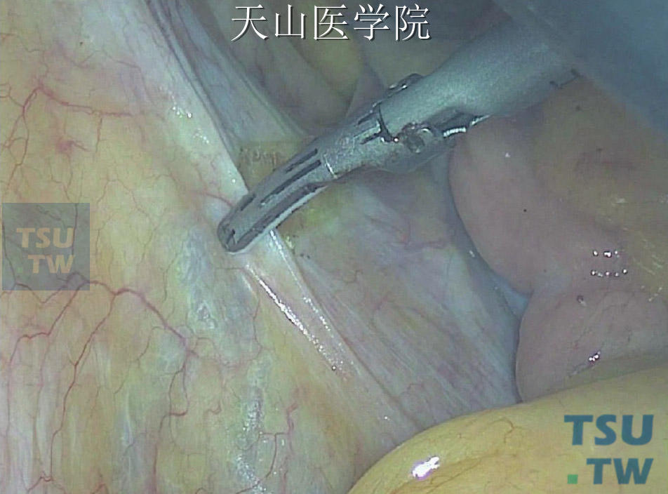 从右侧打开乙状结肠系膜