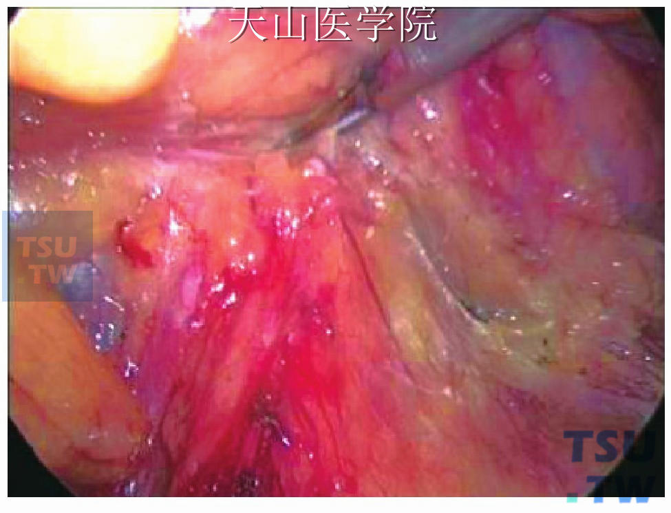 在右侧继续向盆腔分离