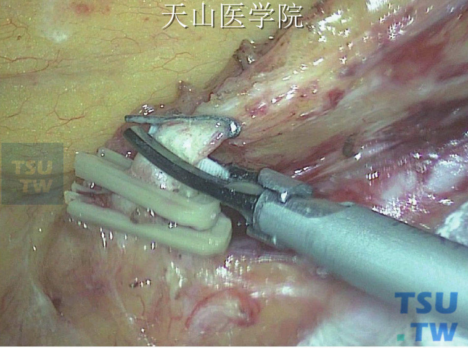 根部离断肠系膜下动脉