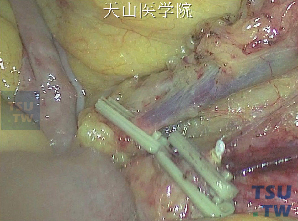 根部离断肠系膜下动脉