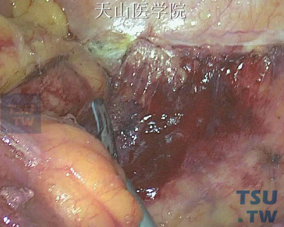 沿左侧同法打开乙状结肠系膜