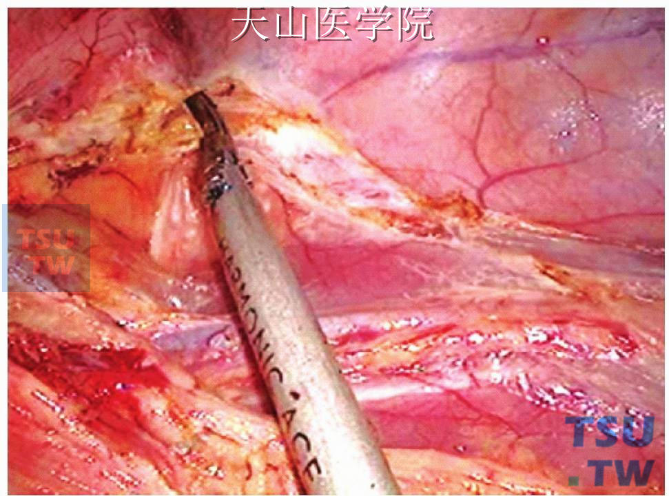 注意勿损伤左输尿管