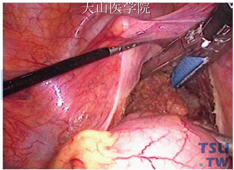 腹腔镜直肠癌根治术（Dixon术）