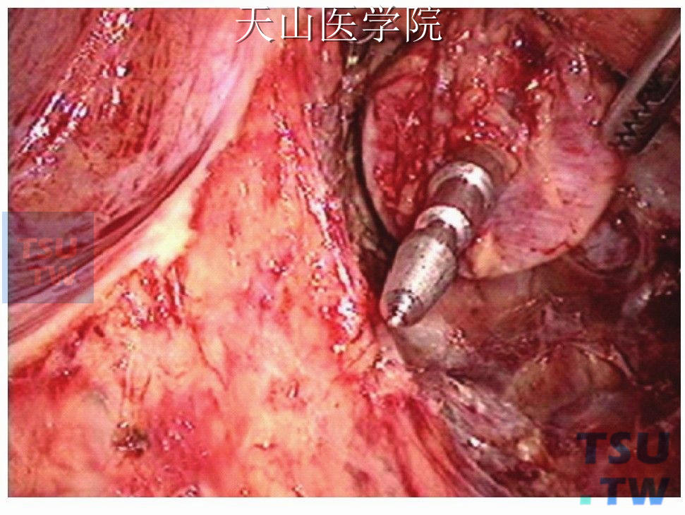 圆形吻合器钉锥经肛门穿出