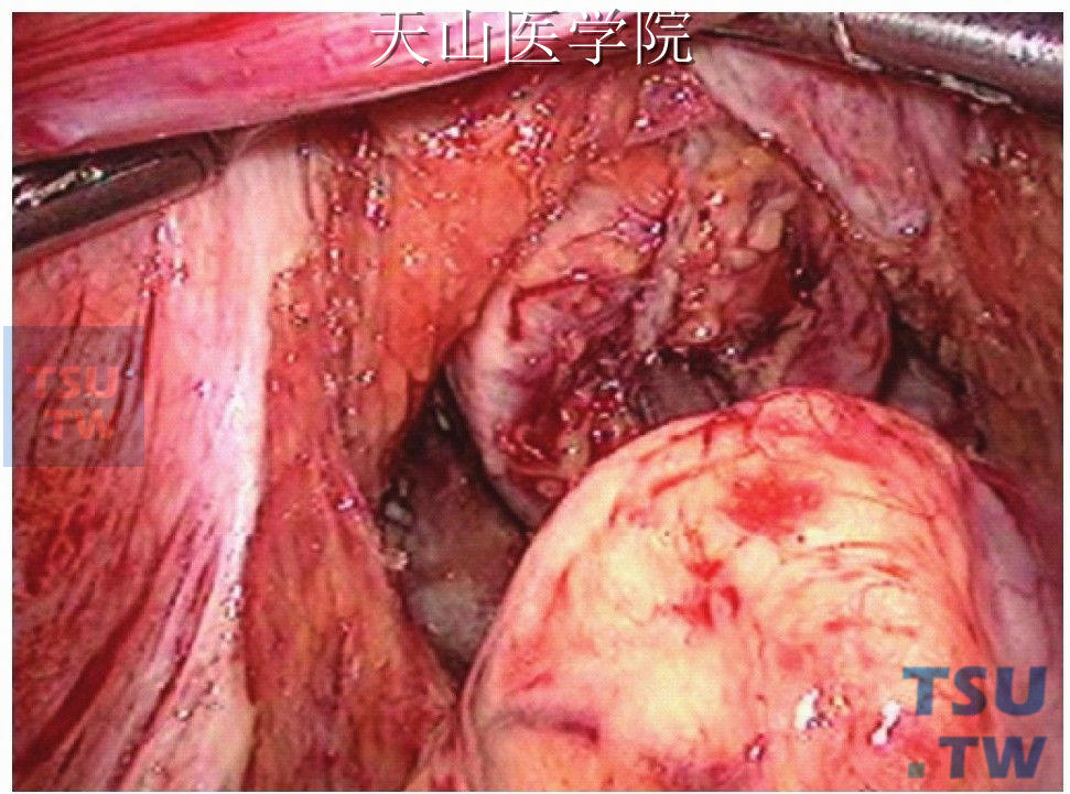 收紧，准备击发吻合