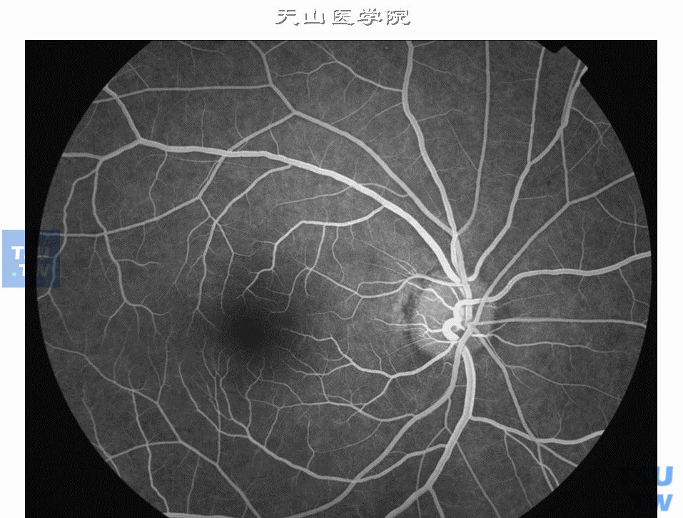 正常眼底荧光造影及临床分期