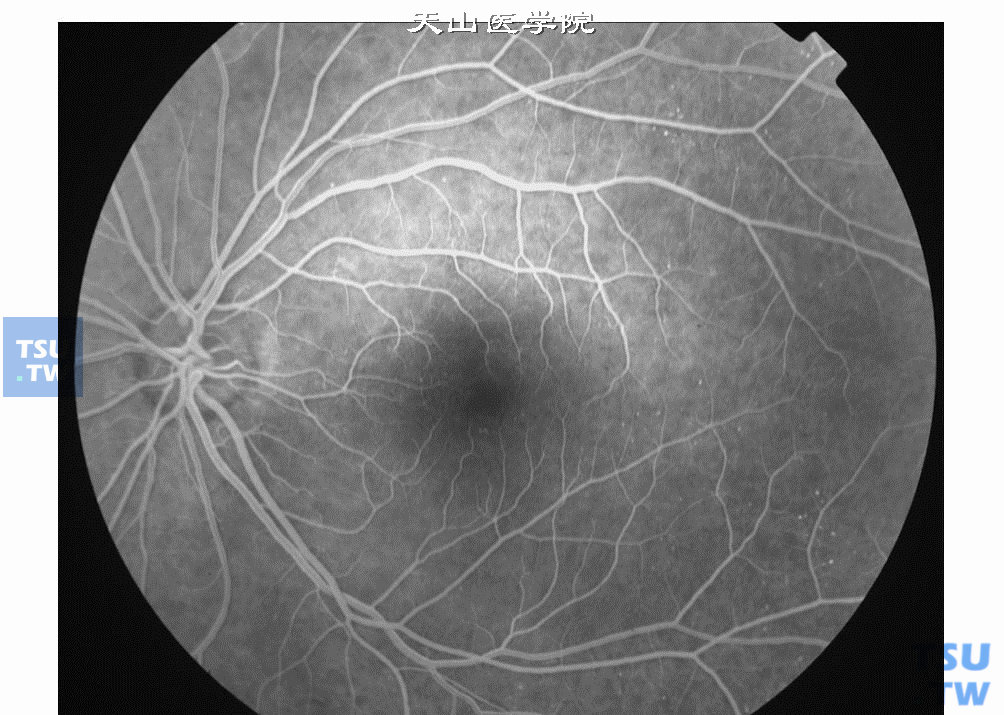  非增生性糖尿病视网膜病变Ⅰ期，颞侧血管弓处可见散在强荧光点