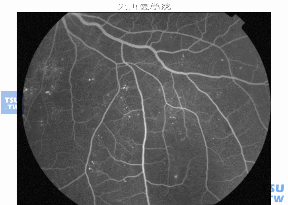  非增生性糖尿病视网膜病变Ⅰ期，下方大量的强荧光点为微血管瘤