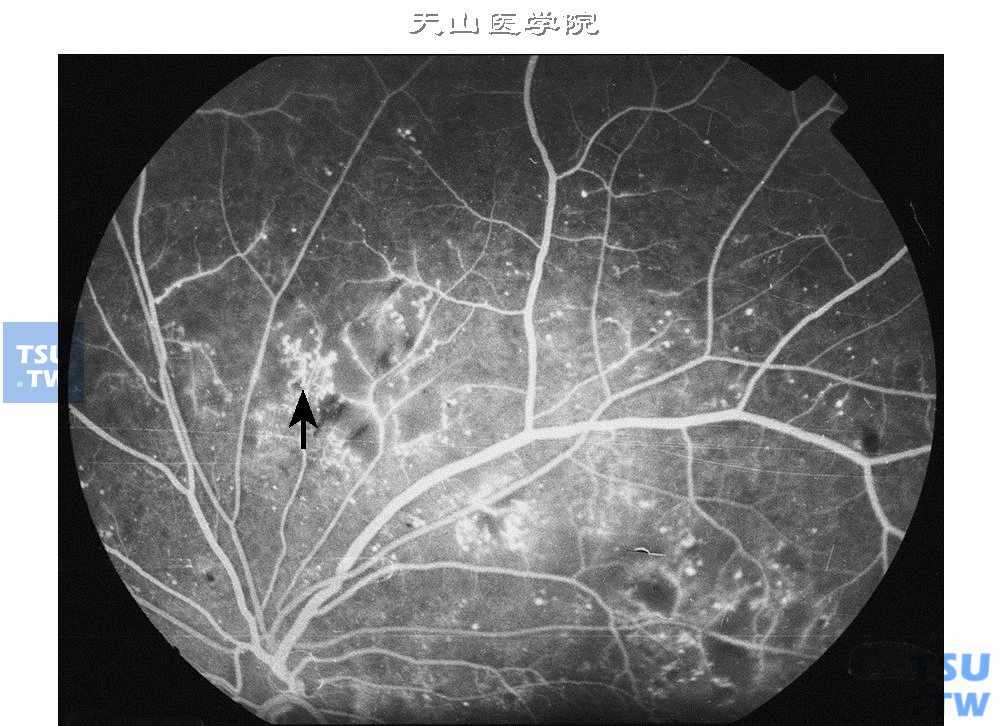  非增生性糖尿病视网膜病变，多数散在的强荧光点，和视网膜内微血管异常（箭头所指），及毛细血管无灌注区