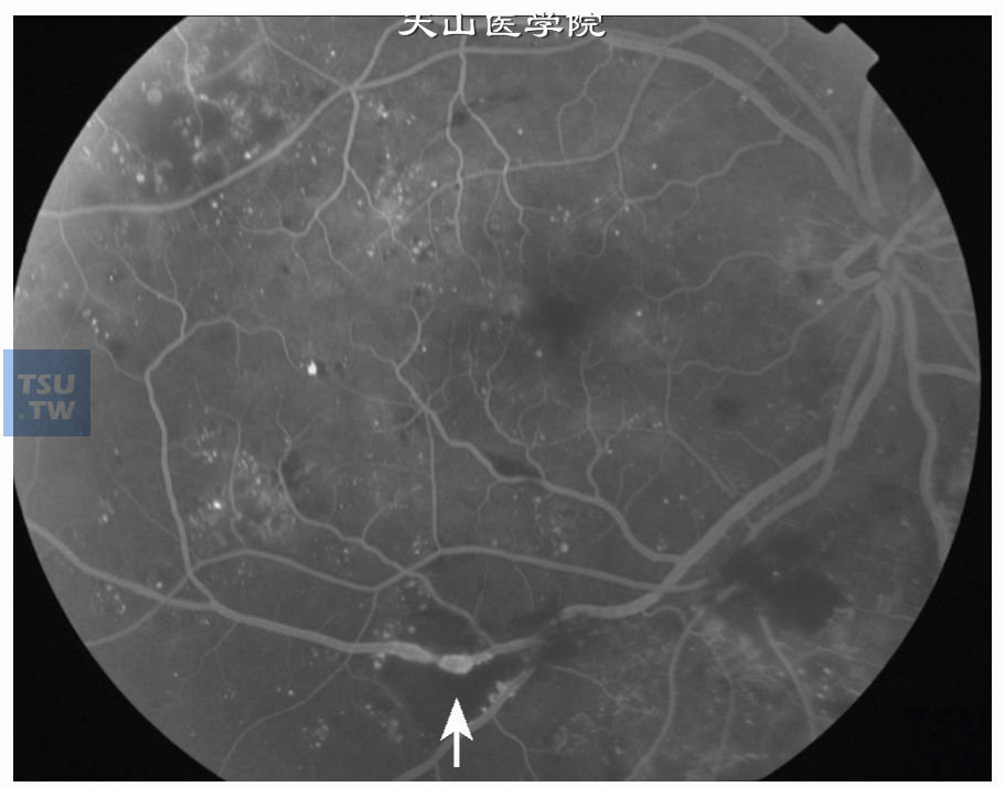  中度非增生性糖尿病视网膜病变，静脉串珠（箭头），累及一个象限