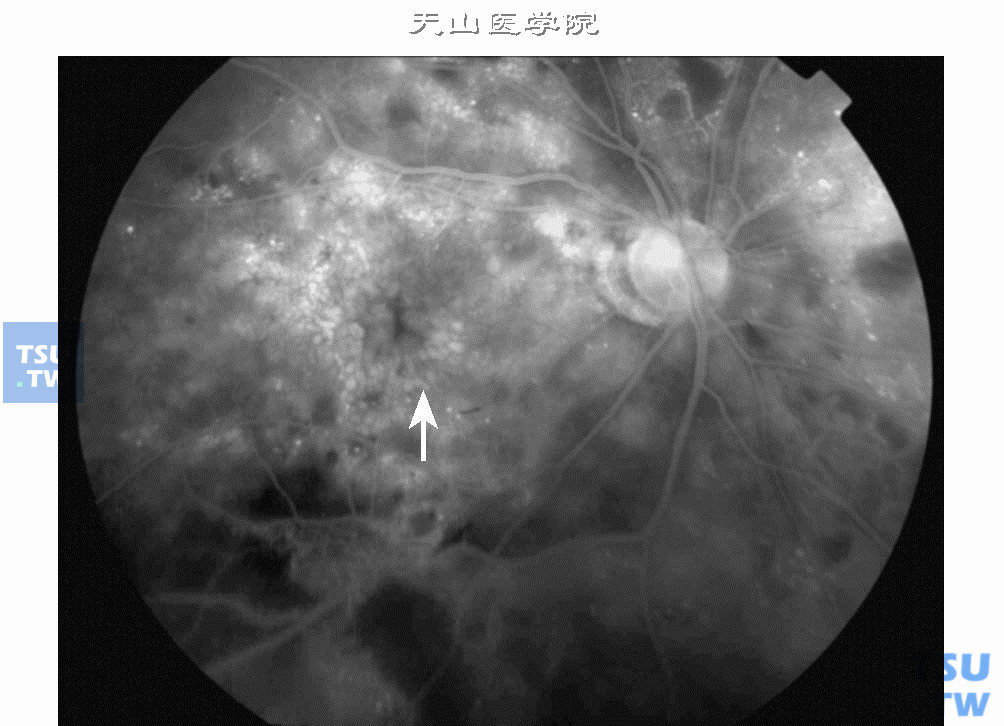 糖尿病性视网膜病变：黄斑病变