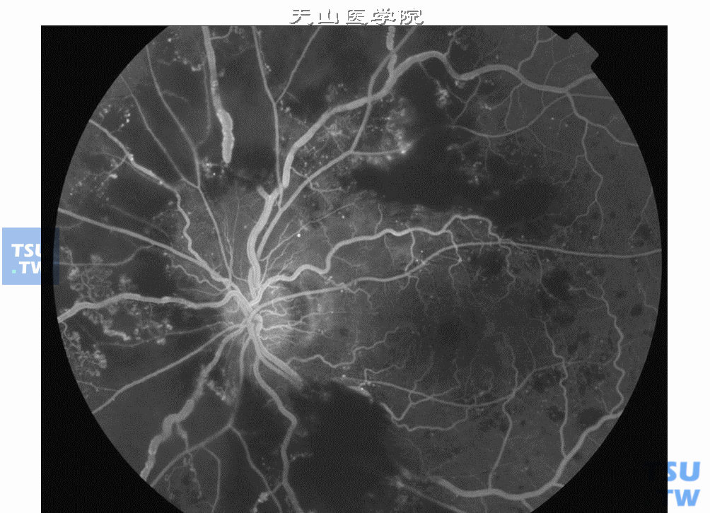  严重非增生性糖尿病视网膜病变，视网膜静脉串珠累及三个象限。大片毛细血管灌注区