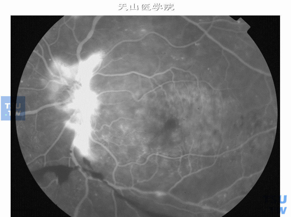  增生性糖尿病视网膜病变，图中显示视盘新生血管和纤维增生，动静脉期荧光渗漏明显，黄斑部轻度荧光渗漏